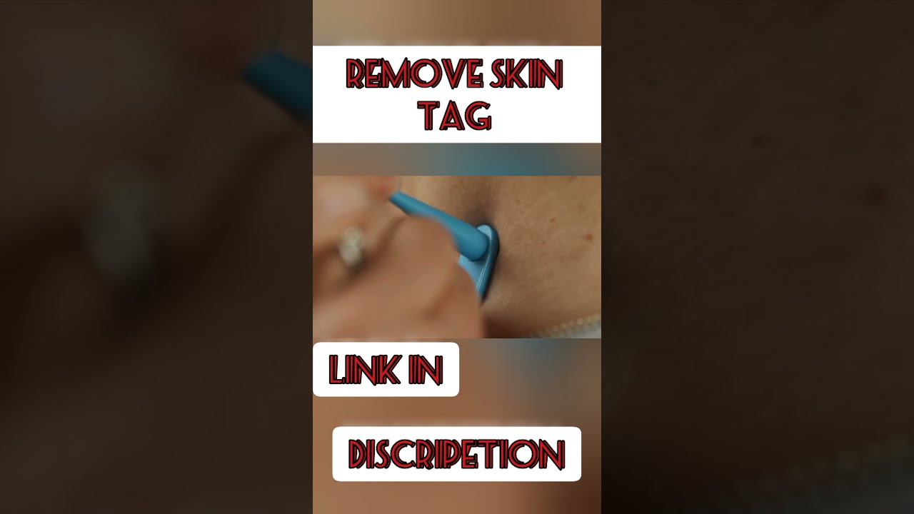 Original TagBand Micro Skin Tag Remover