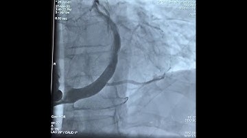 CRT-D implantation  (implante de ressincronizador + desfibrilador).