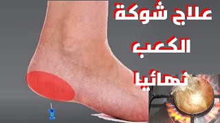 كيف تتخلص من الشوكه العظميه وألم كعب القدم في 3 أيام فقط ؟! علاج الشوكه العظميه والام كعب القدم