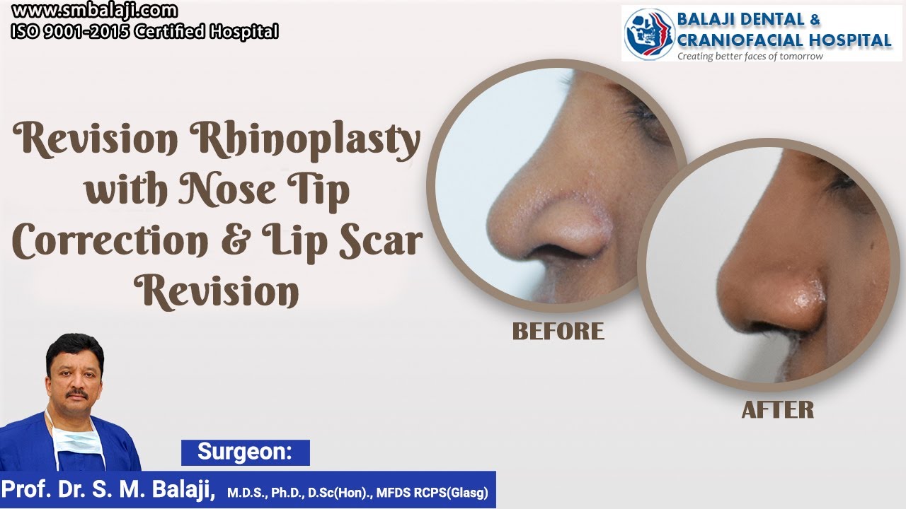 Revision Rhinoplasty with Nose Tip Correction & Lip Scar Revision YouTube