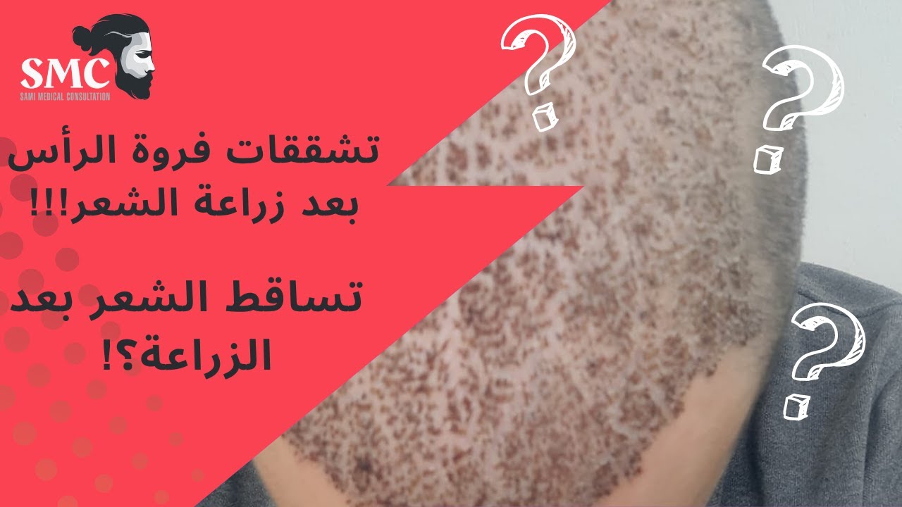 المستشار سامي- تشققات فروة الراس خلال اول اسبوع وتساقط الشعر المزروع