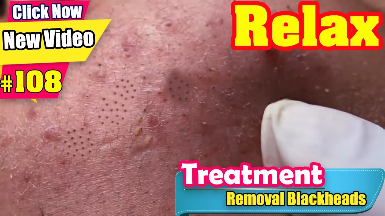 Relax Removal Blackheads Under Skin Male -  Acne Treatment #108