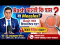বাচ্চার শরীরে Rash মানেই কি হাম বা Measles? Rash আর কিসে কিসে হয়? কখন চিন্তিত হবেন?