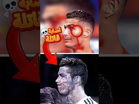 اصابة كادت أن تنهي مسيرة رونالدو مع ريال مدريد أسوأ اصابة 