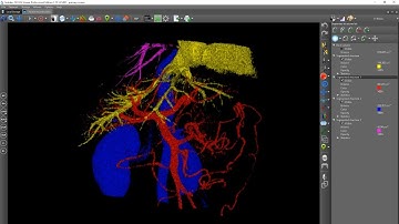 Marked watershed segmentation: abdomen vessels