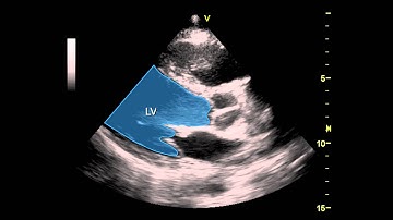 Parasternal Long Axis View