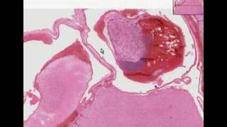 Histopathology Brain--Arteriovenous malformation