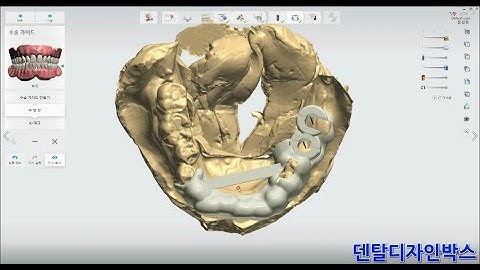 핫한꿀팁! 누구나 따라만 하면 된다! 3shape Implant Studio(임플란트스튜디오)로 Sugical Guide(서지컬 가이드) 제작하는 방법.
