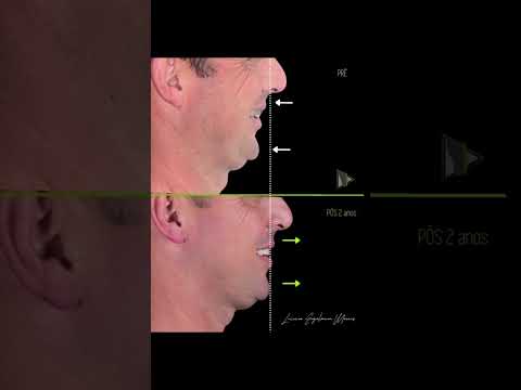 Cirurgia Ortognática Minimamente