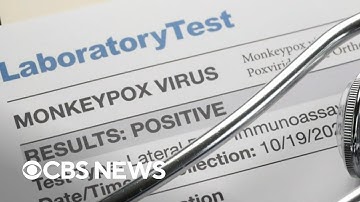 Monkeypox cases spreading worldwide