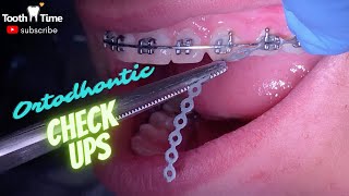 Braces Check Ups - Power chains and rubber ties refresh - Tooth Time Family Dentistry New Braunfels