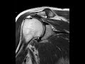 Rotator cuff tear  first look mri