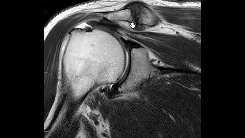 Rotator cuff tear | First Look MRI