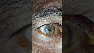 corneal opacity with cataract #shortvideo #eyes #corneal #opacity