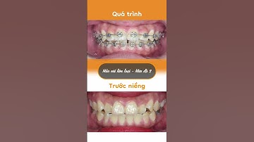 Hành trình LỘT XÁC nhờ niềng răng của Phương Uyên