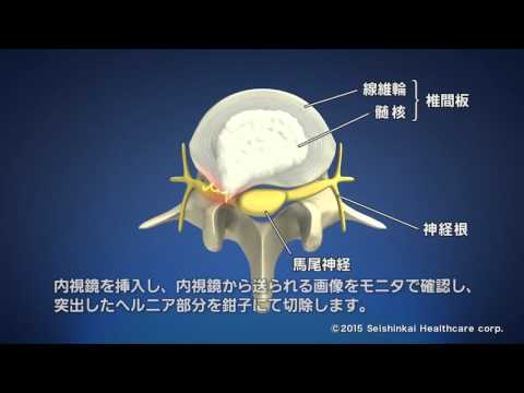 FESS 全内視鏡下椎間板切除術（Full Endoscopic Spinal Surgery