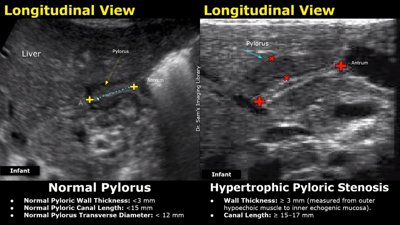 Stomach Ultrasound Normal Vs Abnormal | Antrum & Pylorus Scan | Pediatric & Adult Gastric USG Cases