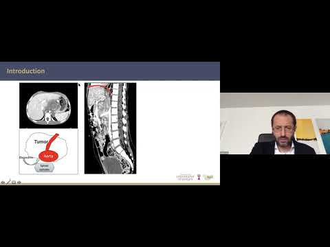 SIOP2021: Two-cavity approach for resection of pediatric abdominal neuroblastic tumors