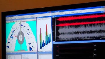 Dr. Patel explains his T-Scan Bite Analysis technology