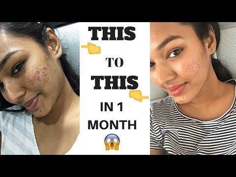  PRODUCT THAT REDUCED MY ACNE SCARS IN ONE MONTH | Sarah Sarosh