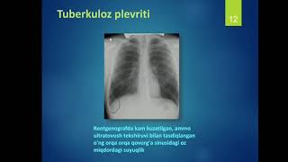 O‘pkadan tashqari a‘zolar tuberkulyozi  Tuberkulyoz plevriti  Tuberkulyoz va OIV  OITS, zamonaviy ep