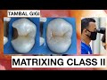 Step by step matrixing class ii premolar  general dentist griya rr