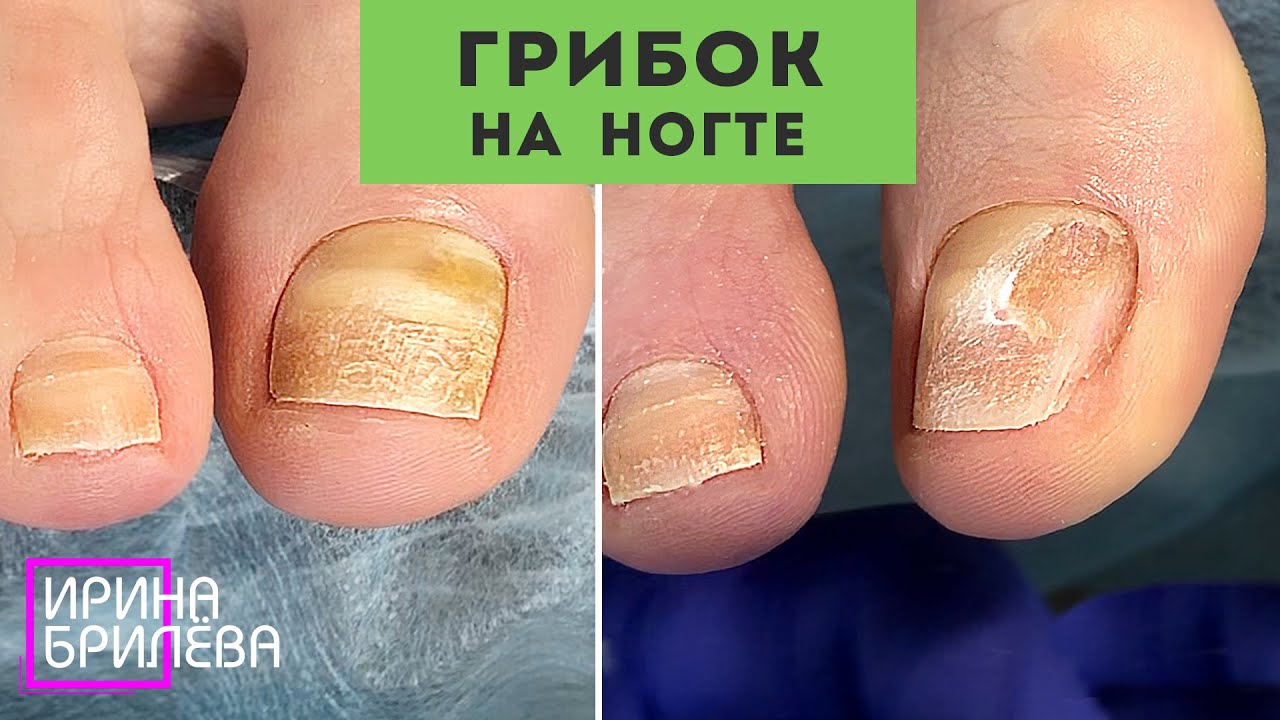 ГРИБОК на большом пальце 🌸 ЧТО ДЕЛАТЬ и как реагировать? 🌸 Проблемный ...