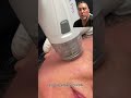 Radio Frequency Microneedling for Facial Rejuvenation