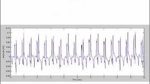ECG signal filtering
