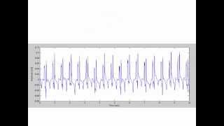 ECG signal filtering