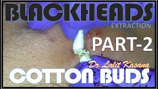 BLACKHEAD EXTRACTION WITH COTTON BUDS PART - 2