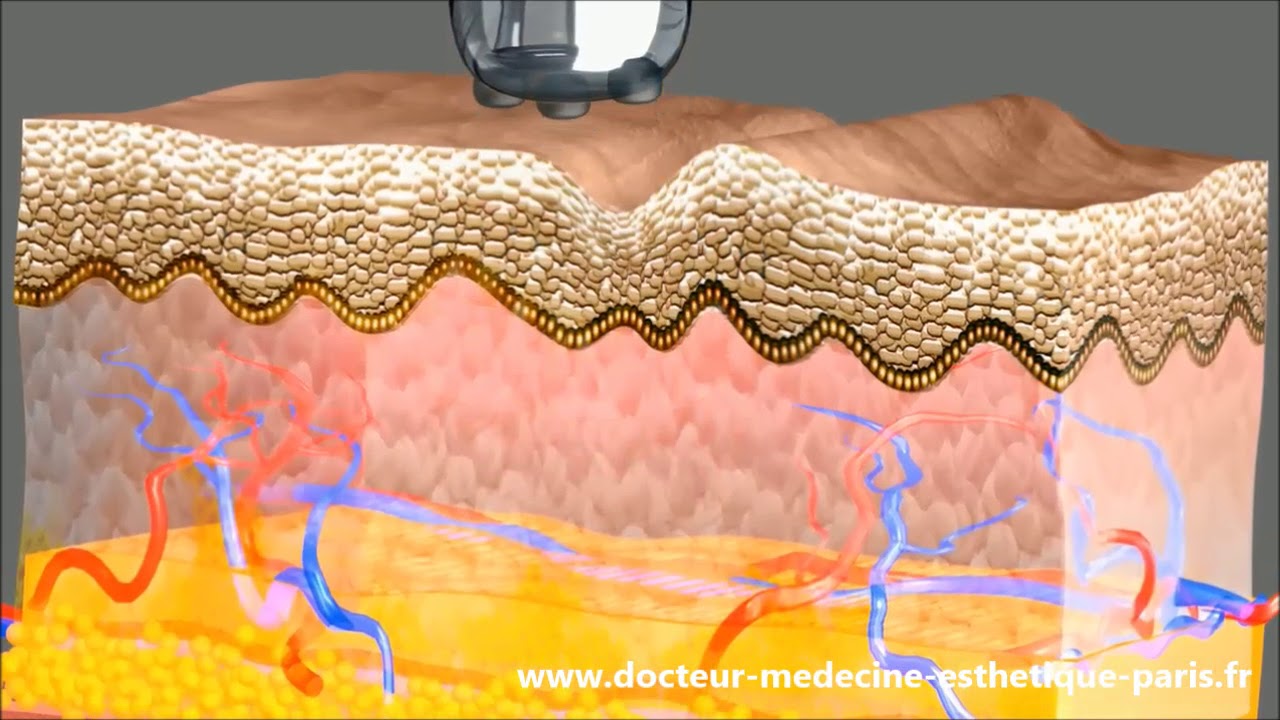 Radiofréquence fractionné à Paris - Dr Aida Cheriet