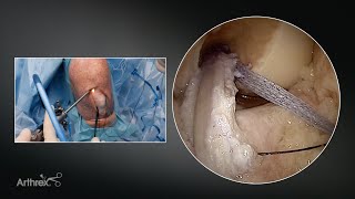 Independent FiberTape® Suture Routing for ACL Reconstruction Using the InternalBrace™ Technique