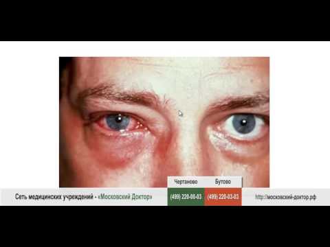 Воспаление глаз у взрослых и детей