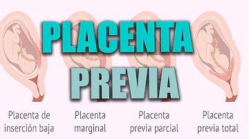 ¿Qué tipo de placenta es normal?