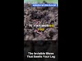 The Invisible Worm That Swells Your Leg