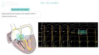 AVJRT post pacing interval - sample from EP in Practice