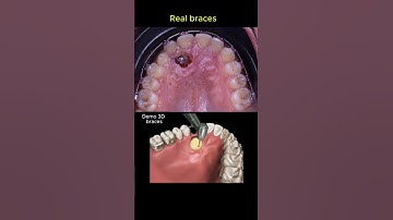 Impacted tooth traction with braces #orthodontist #braces #dentist