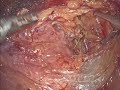 Managing uterine vessel bleed at tlh  naration 