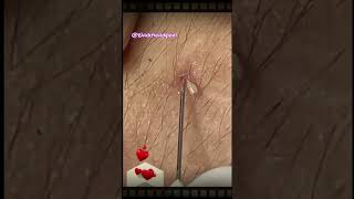 Relax Blackhead Removal 087  shorts  blackhead  acne  pimplesremoval  satisfying