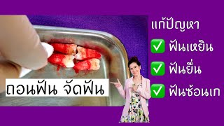 รีวิวจัดฟันแก้ฟันเขี้ยวซ้อนให้ฟันเรียบสวย/dental point pattaya /โดยหมอหลิน