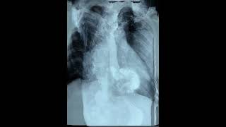 Рентгеноскопия пищевода, желудка и двенадцатиперстной кишки