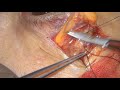 ※手術動画（閲覧注意）　巨大涙腺腫瘍摘出の動画（13min）Surgical excisional video for huge lacrimal grand tumor!