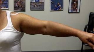 9 Days Post Surgery (Pre-Treatment Range of Motion)