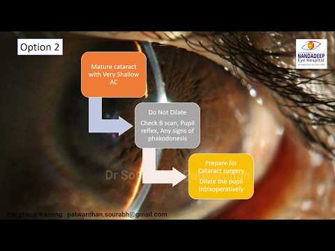 Mature cataract with very shallow AC- Intraoperative dilatation- Dr Sourabh Patwardhan