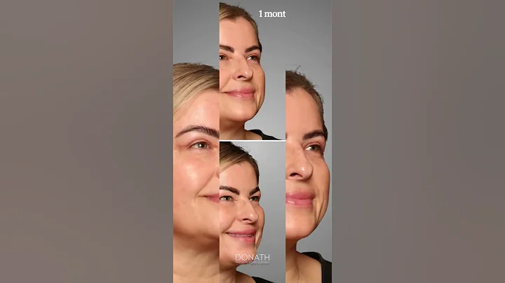 1 Month After Eyelid Surgery – Just LOOK at These Results! 👀✨ #Blepharoplasty #facialplasticsurgery