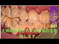 大規模な歯石の洗浄-歯石の除去 🦷 [Remove Massive Hidden Teeth Tartar] #042 DentalClinic