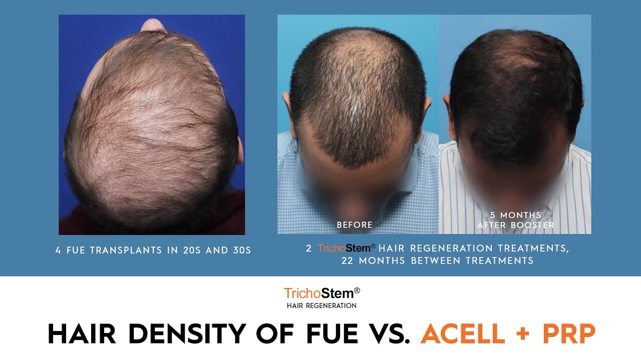 Factors in Choosing FUE Hair Transplant, or ACell PRP Treatment - YouTube