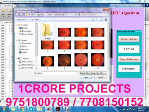 Texture Analysis for Glaucoma Classification Using BRIEF Algorithm - Matlab - 1Crore Projects