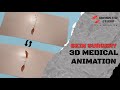 Skin Surgical Animation | Medical Animation